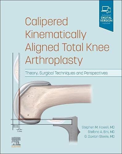 Calipered Kinematically Aligned Total Knee Arthroplasty 1st/2022