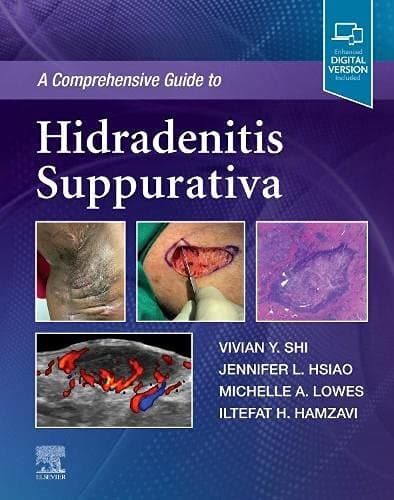 A Comprehensive Guide to Hidradenitis Suppurativa 1st/2022