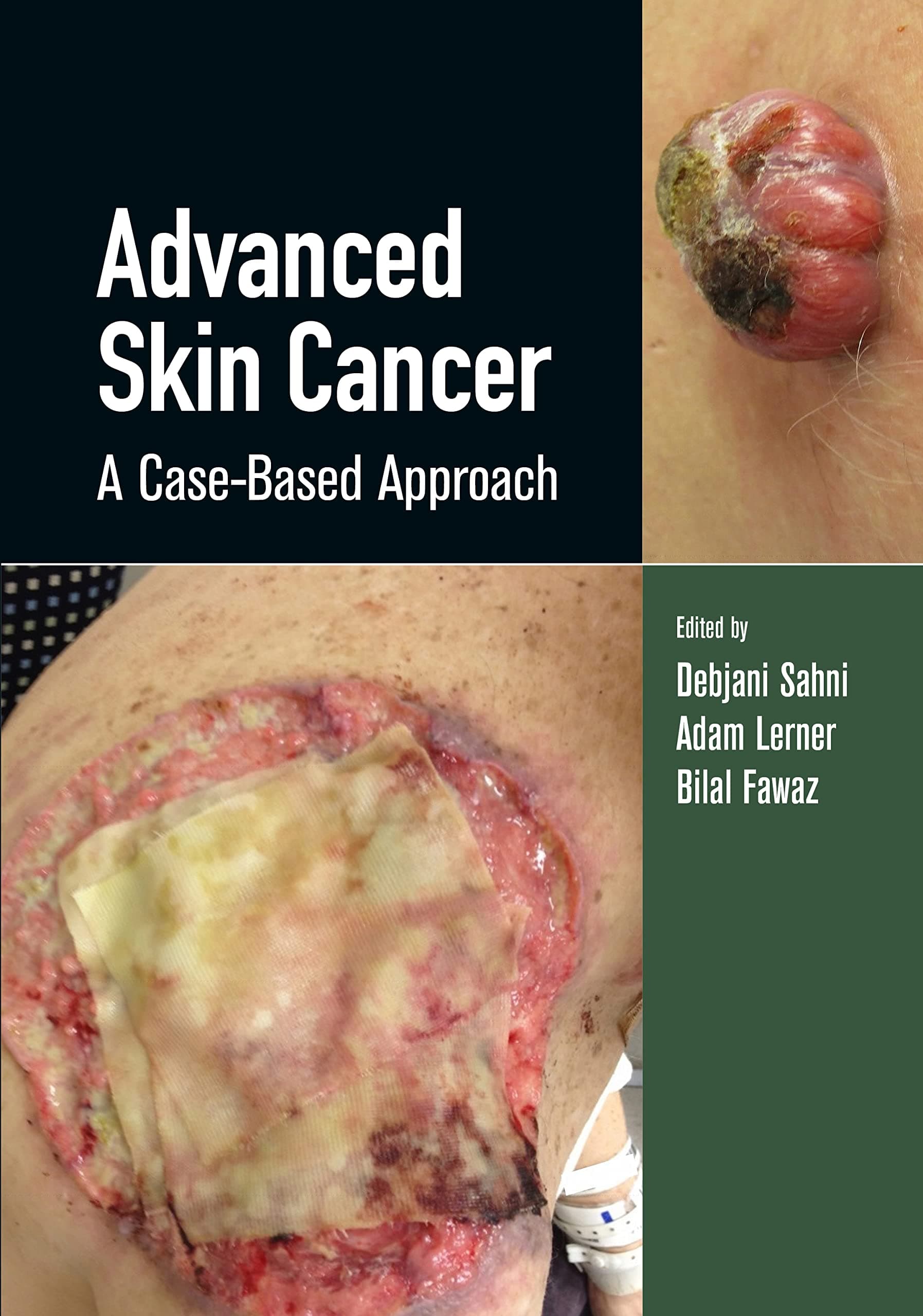 Advanced Skin Cancer 1st/2022