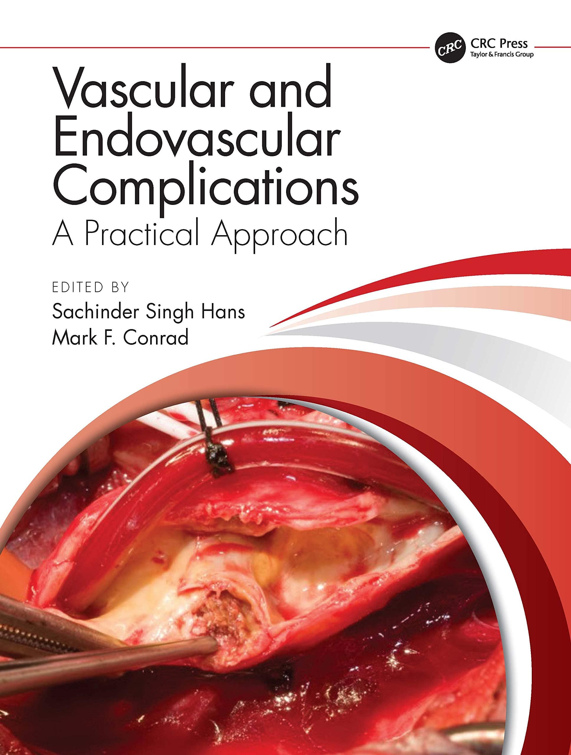 Vascular and Endovascular Complications A Practical Approach 1st/2021