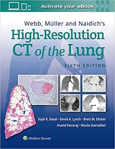Webb, Muller and Naidich's High Resolution CT of the Lung 6th/2021