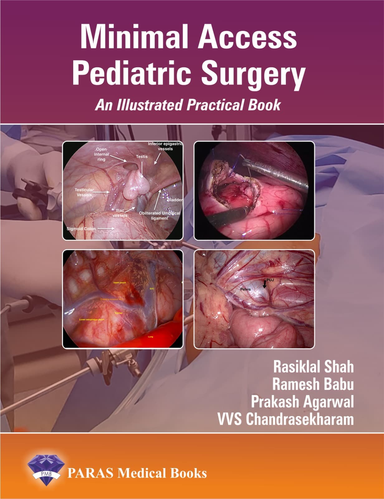 Minimal Access Pediatric Surgery 1st/2025
