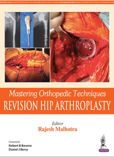 Mastering Orthopedic Techniques Revision Hip Arthroplasty 1st/2017