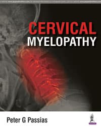 Cervical Myelopathy 1st/2016