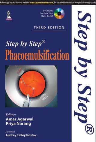 Step by step Phacoemulsification 3rd/2015