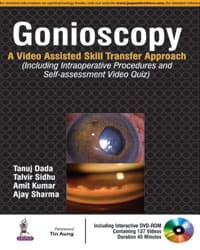 Gonioscopy: A Video Assisted Skill Transfer Approach 1st/2016