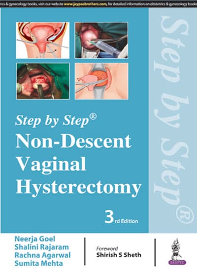 Step by Step Non Descent Vaginal Hysterectomy 3rd/2018180