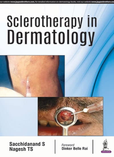 Sclerotherapy in Dermatology 1st/2018