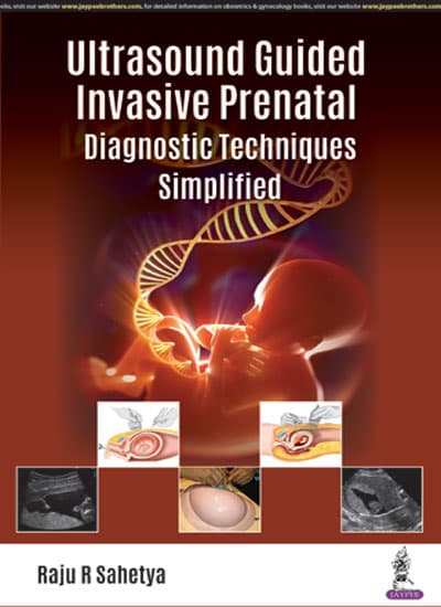 Ultrasound Guided Invasive Prenatal Diagnostic Techniques Simplified 1st/2018
