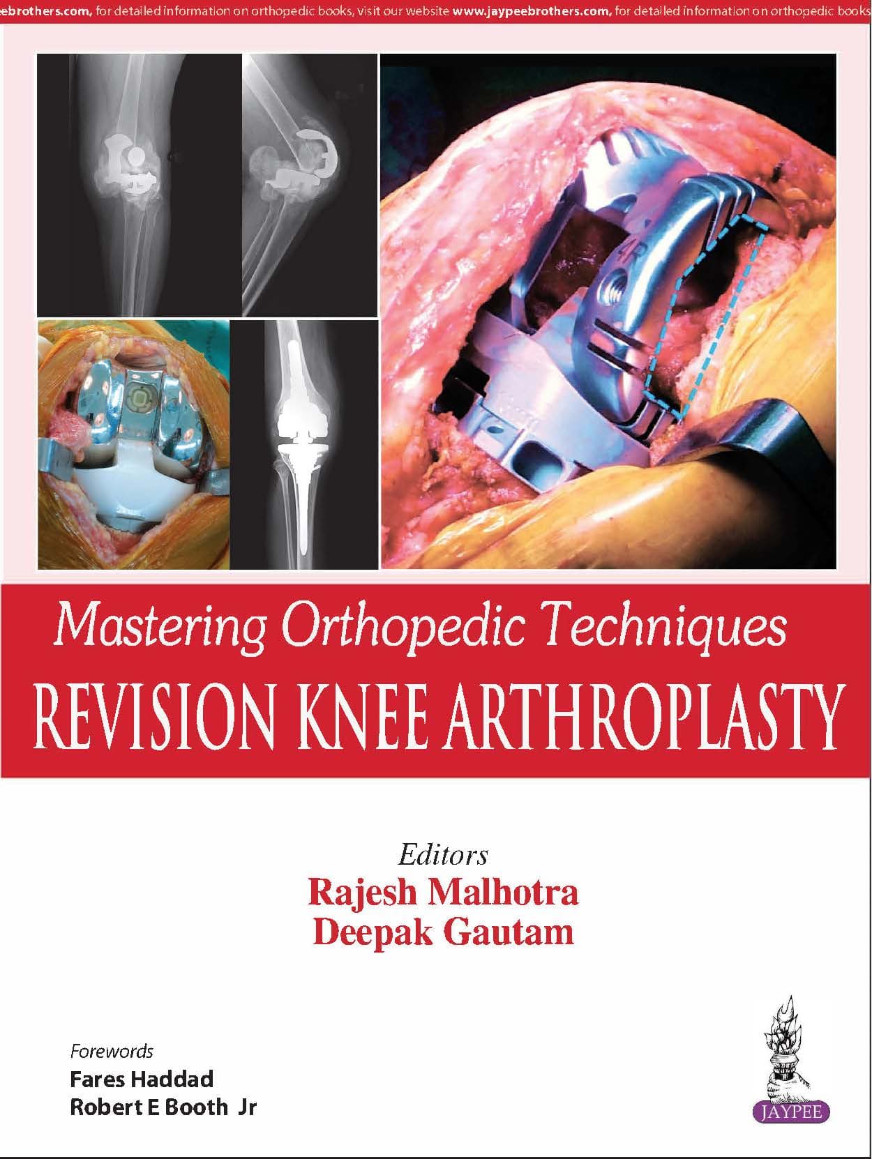 Mastering Orthopedic Techniques Revision Knee Arthroplasty 1st/2019