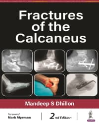 Fractures of the Calcaneus 2nd/2024