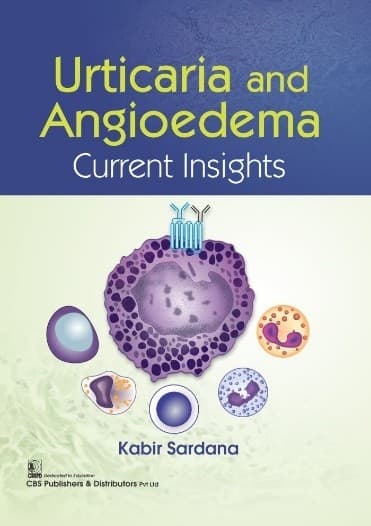 Urticaria And Angioedema Current Insights 1st/2022