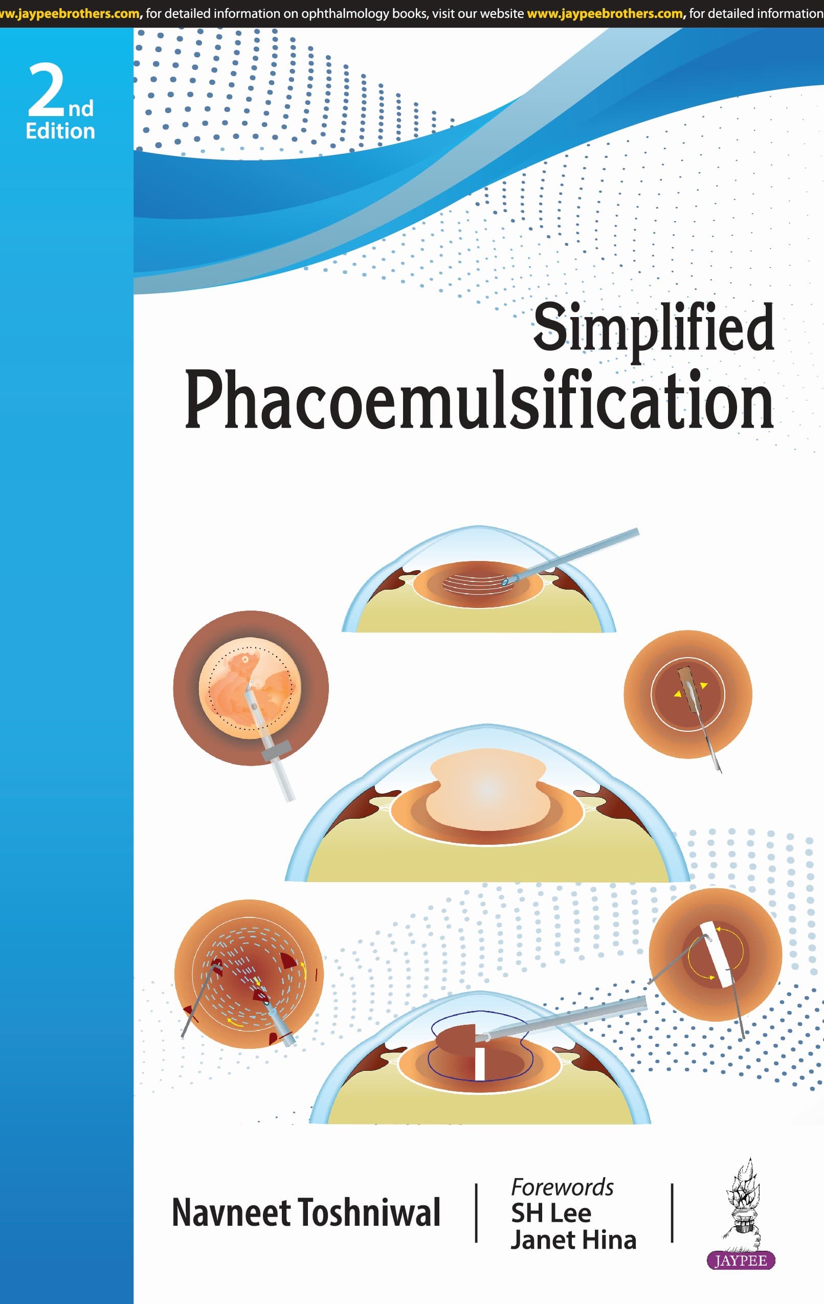 Simplified Phacoemulsification 2nd/2025