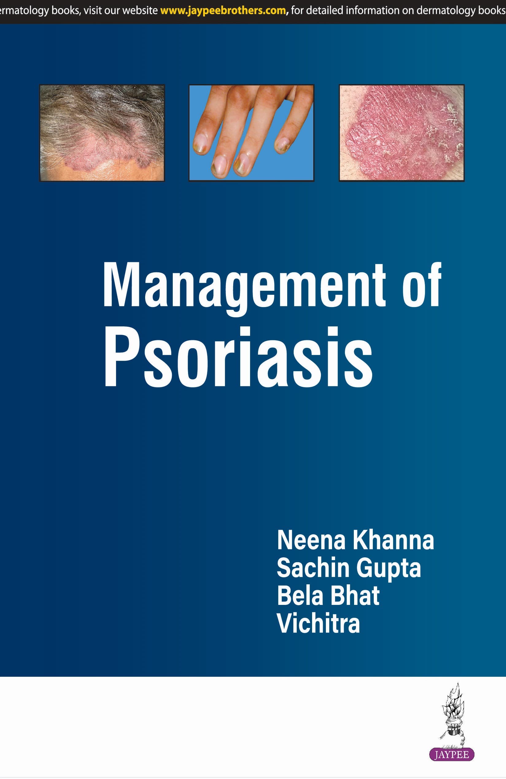 Management of Psoriasis 1st/2025