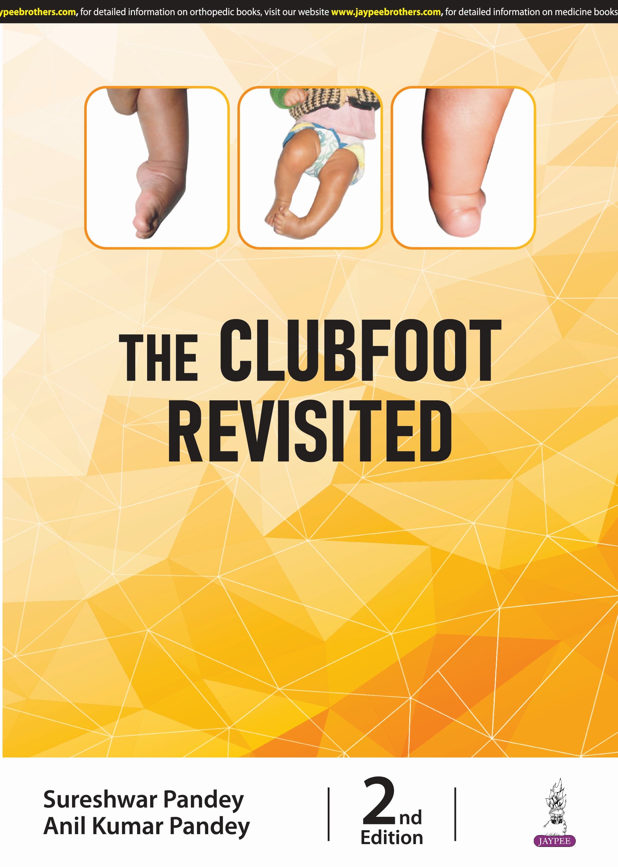 Clubfoot Revisited 2nd/2025