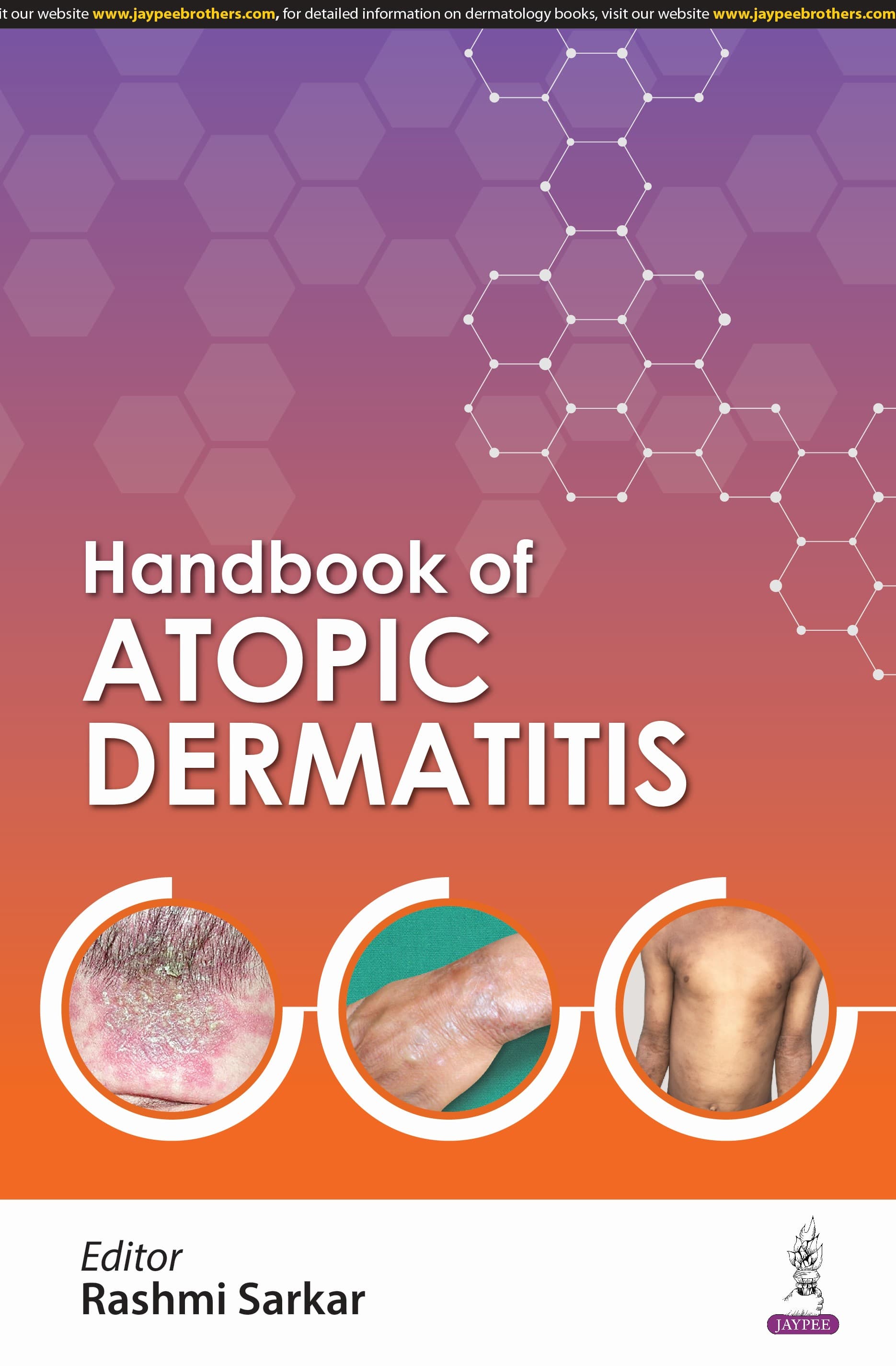 Handbook of Atopic Dermatitis 1st/2025