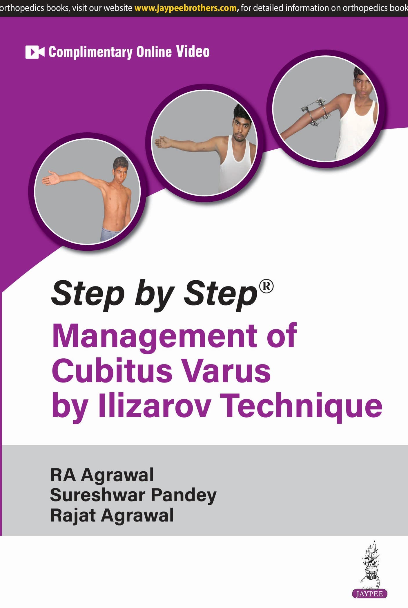 Step by Step Management of Cubitus Varus by Ilizarov Technique 1st/2025