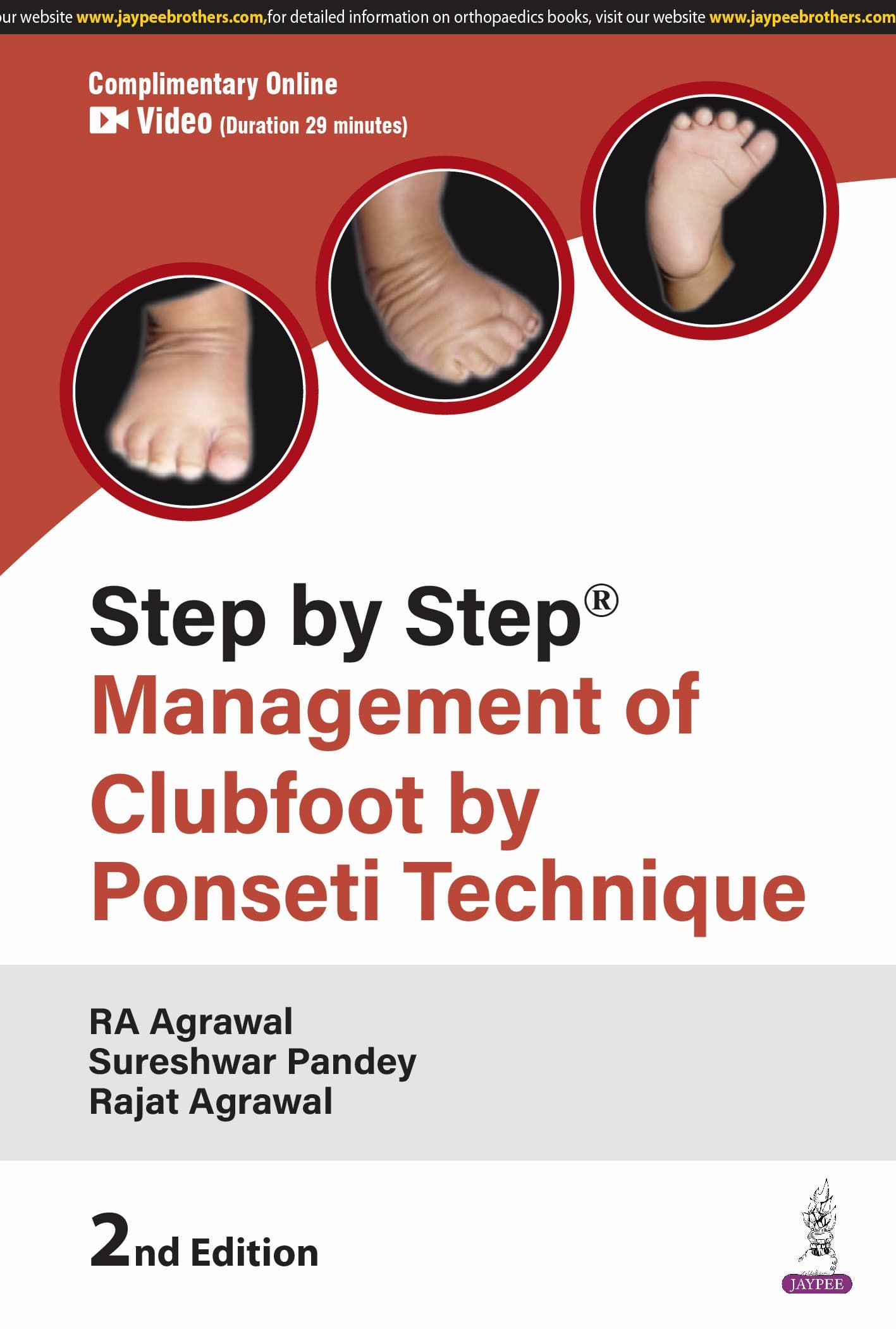 Step by Step Management of Clubfoot by Ponseti Technique  2nd/2025