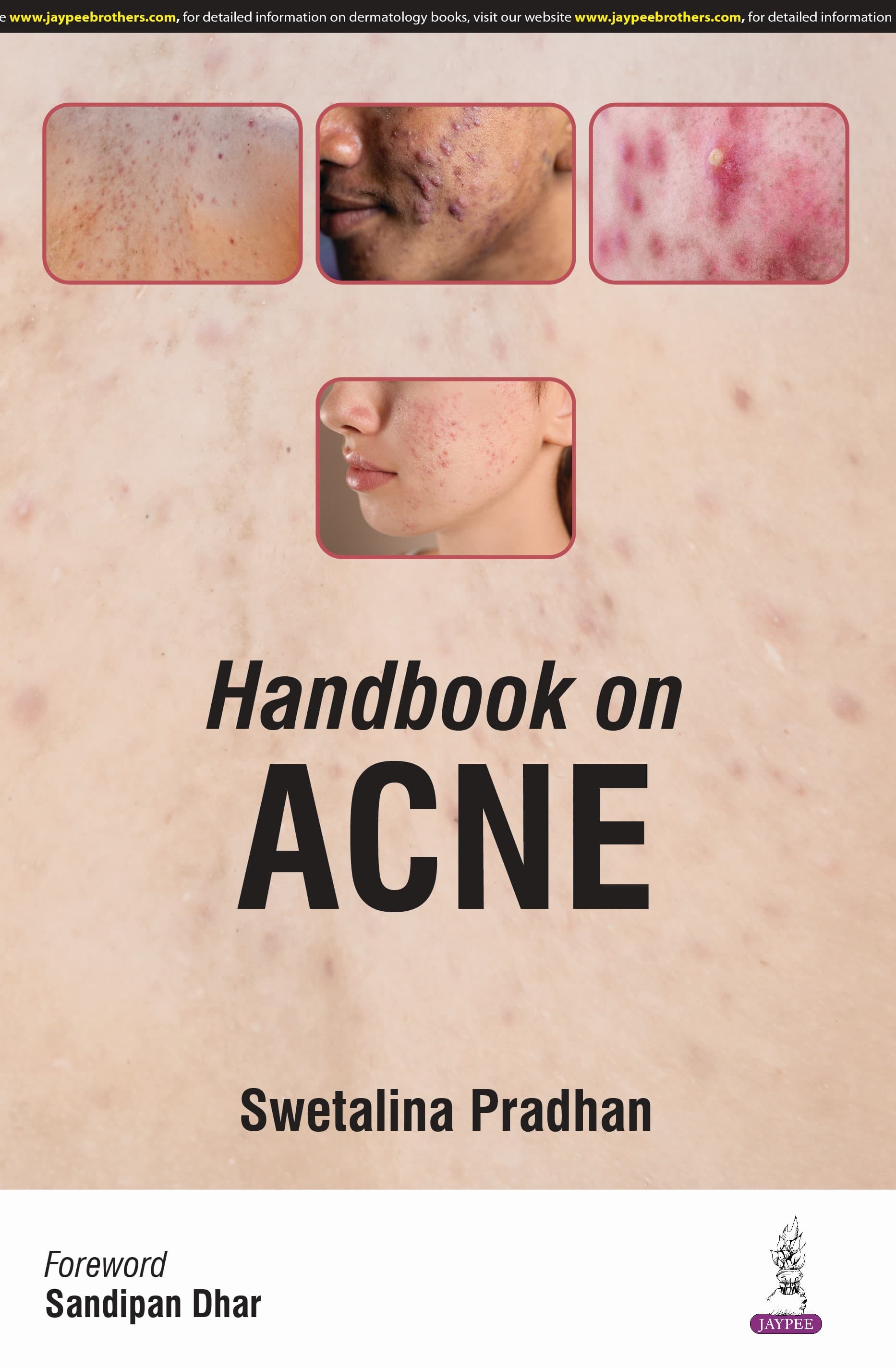 Handbook on Acne 1st/2025