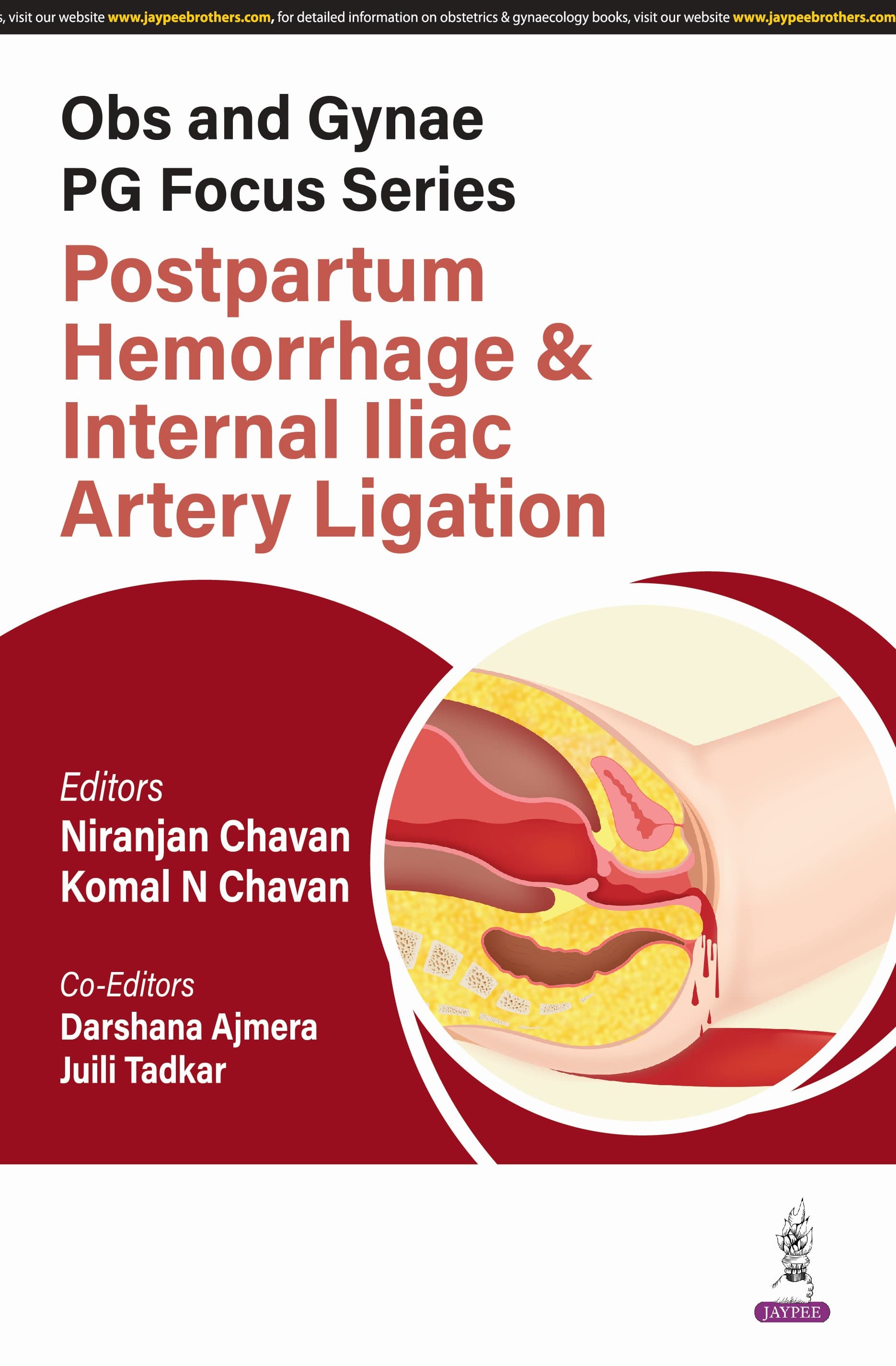 Obs and Gynae PG Focus Series Postpartum Hemorrhage and Internal Iliac Artery Ligation 1st/2025