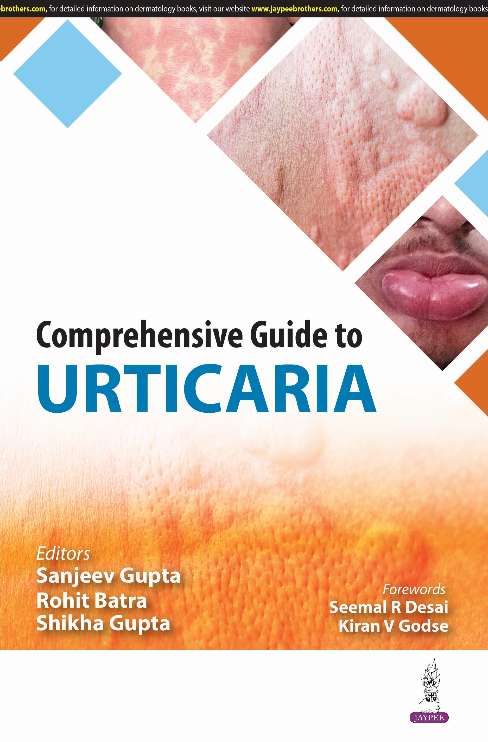 Comprehensive Guide to Urticaria 1st/2025