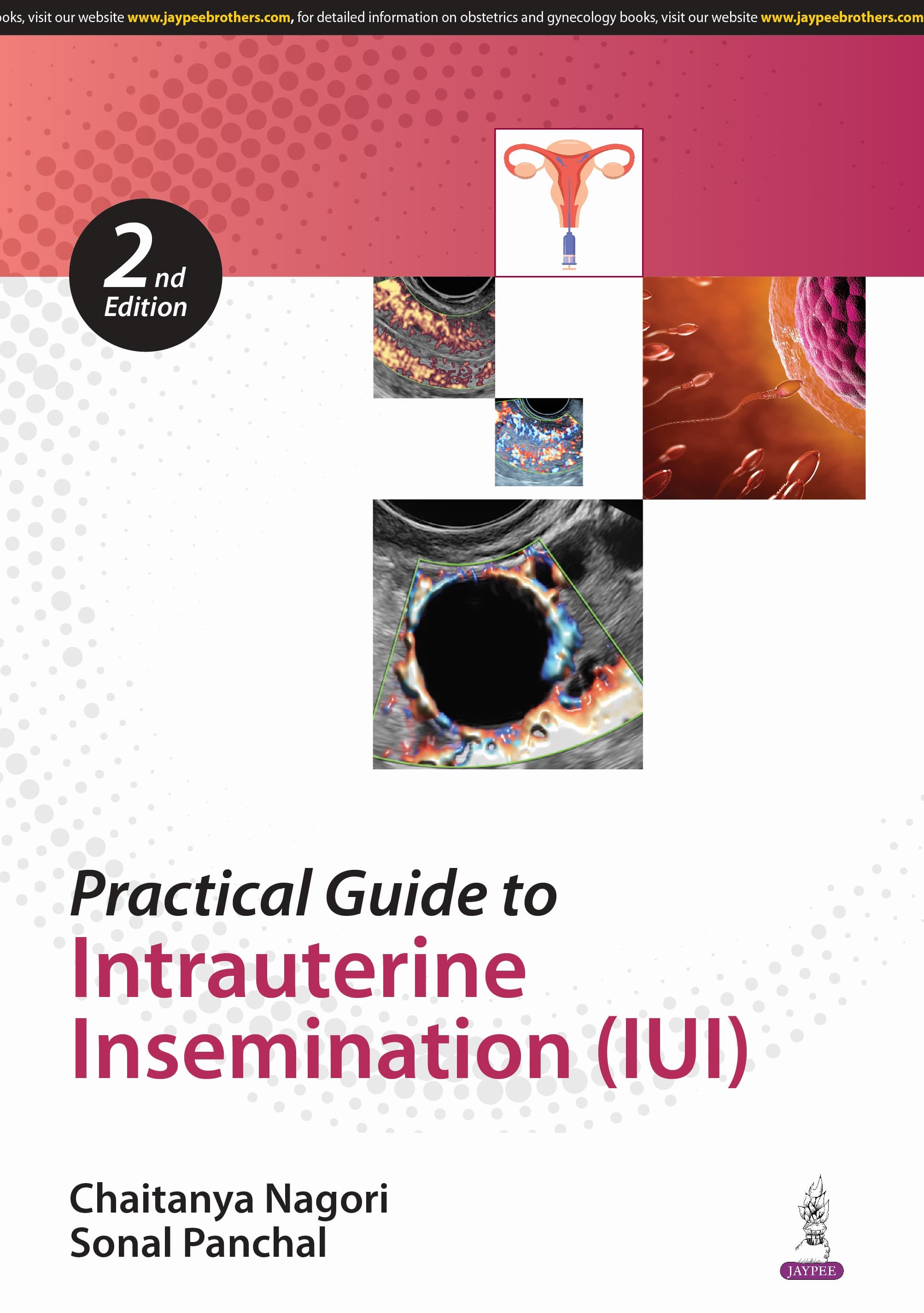 Practical Guide to Intrauterine Insemination (IUI) 2nd/2025
