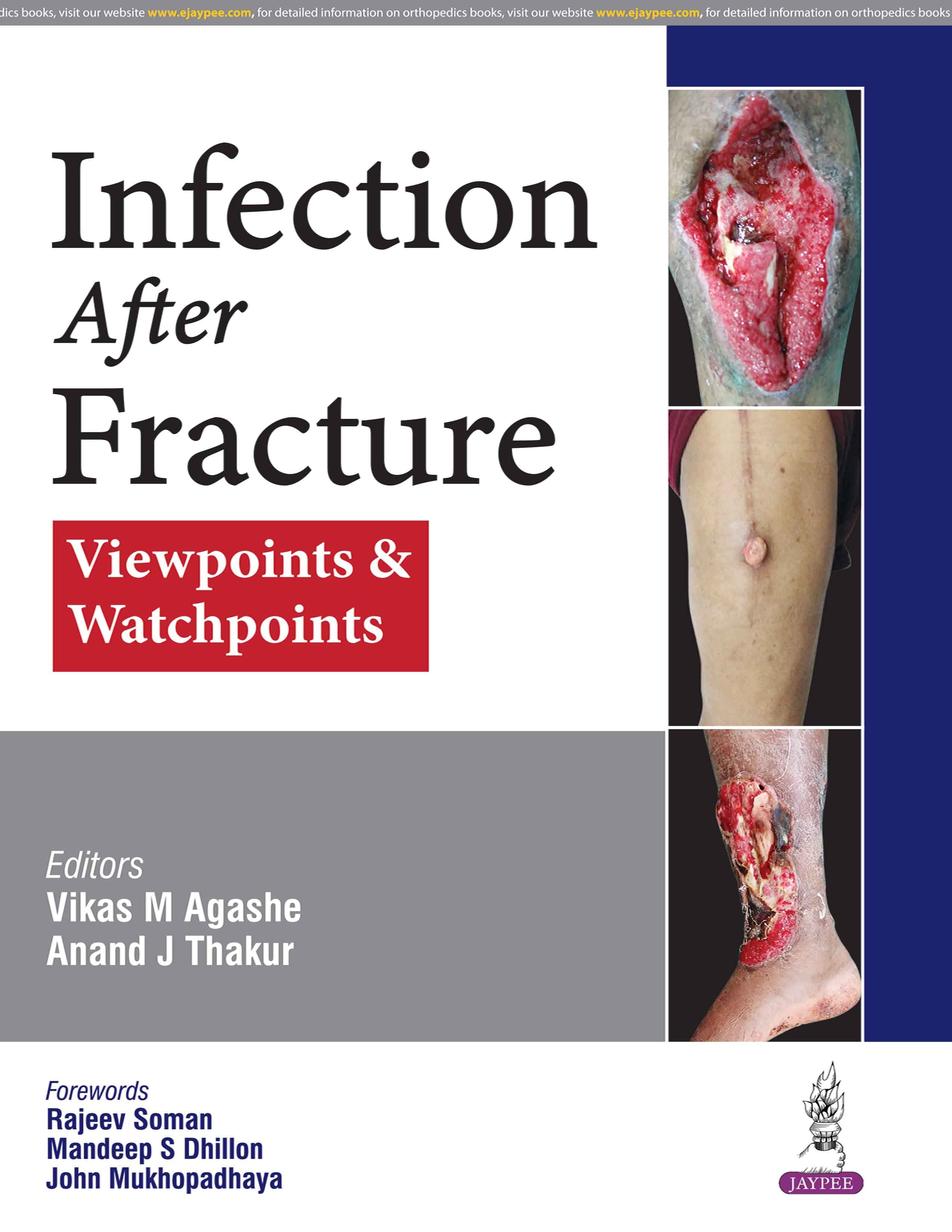 Infection after Fracture 1st/2026