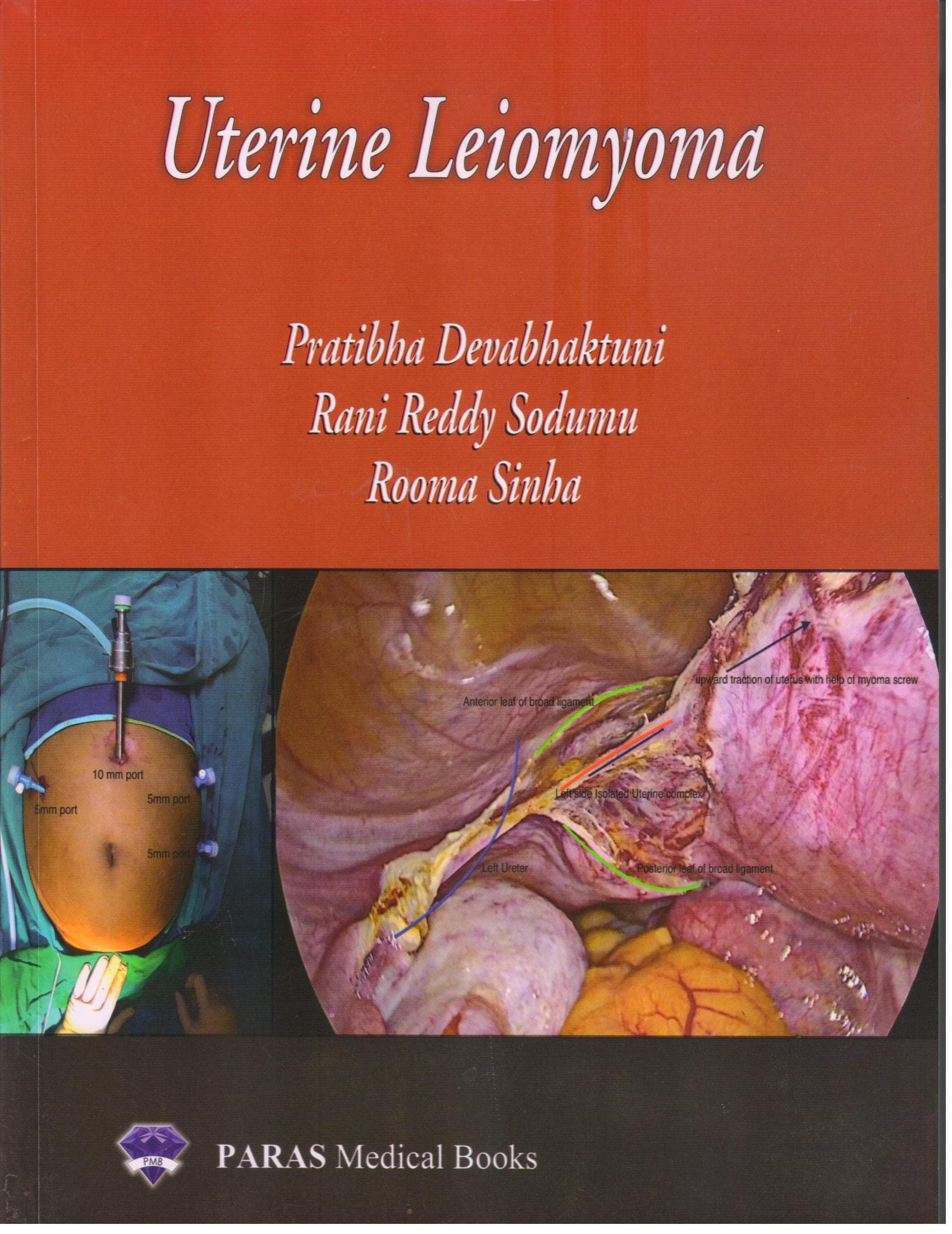 Uterine Leiomyoma 1st/2019