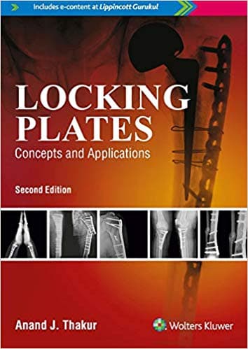 Locking Plates Concepts and Applications 2nd/2018