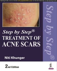 Step by Step Treatment of Acne Scars 2nd/2022