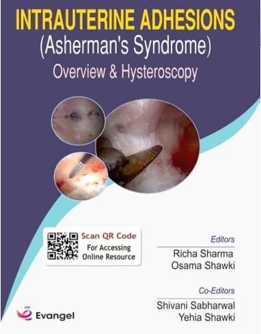 Intrauterine Adhesions Ashermans Syndrome 1st/2021