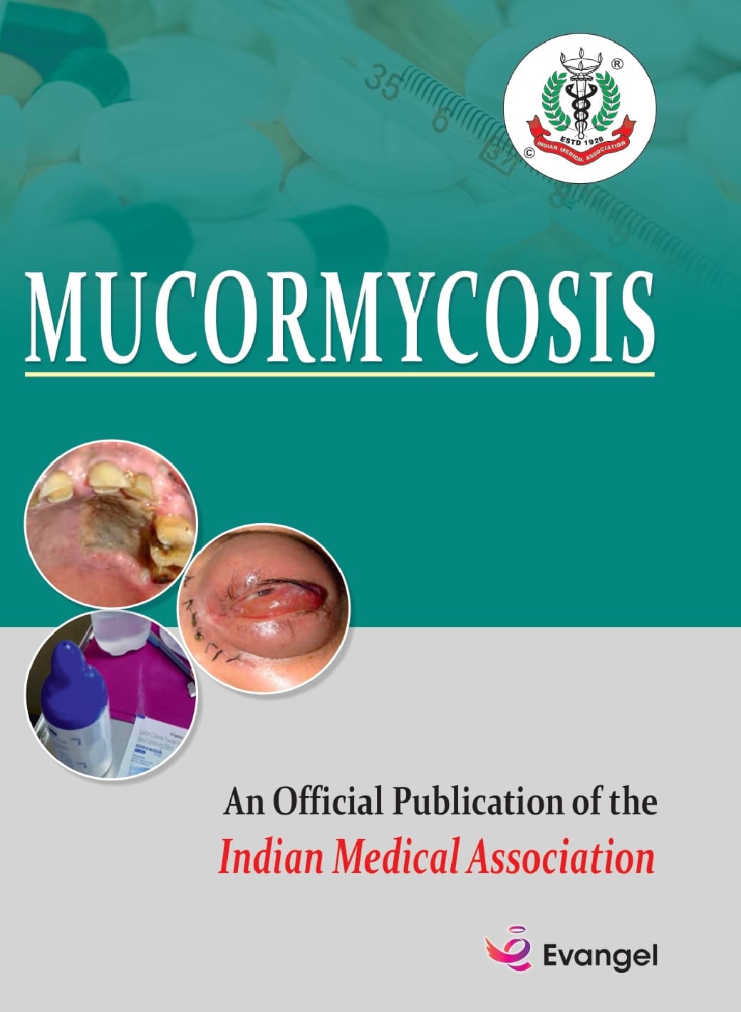 Mucormycosis 1st/2021